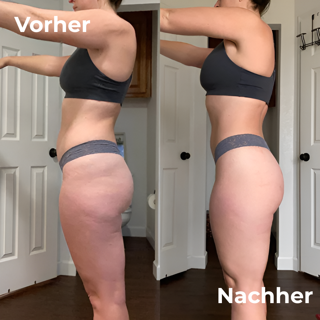 SkinRoll™ | Cellulite-Roller – klarer Bezug zur Haut